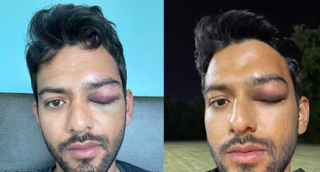 Unmukt Chand suffers eye injury in US