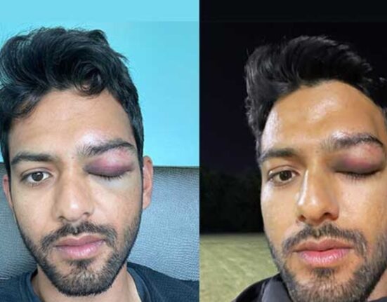 Unmukt Chand suffers eye injury in US